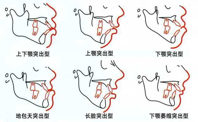 朴兴植:凸嘴手术最重要的是找到适合个人的手
