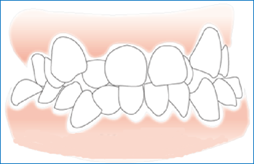 如何改善青少年牙齿咬合关系异常