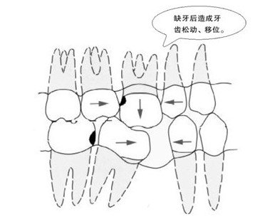 牙齿缺失危害大