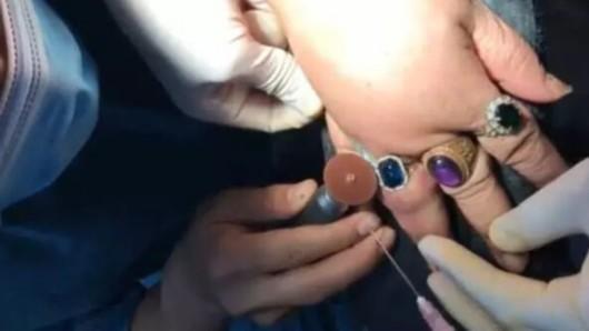 上海惊现“指环王” 阿姨9个手指戴戒指卡住7个