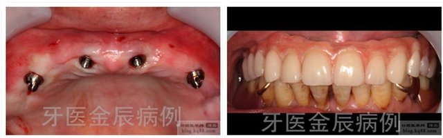 全口/半口牙缺失的最佳解决方案 无痛种植修复