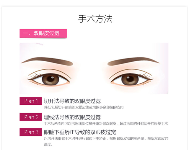 双眼皮修复有三大注意!上海华美4级整形资质