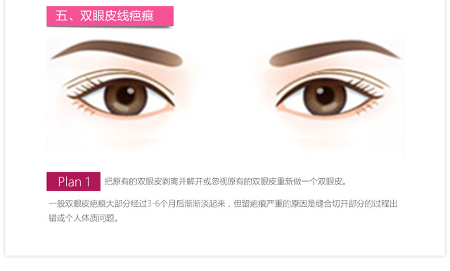 双眼皮修复有三大注意!上海华美4级整形资质