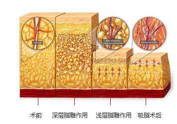 上海华美出事丨上海华美分层紧肤吸脂--因美丽认识你