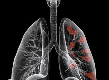 健康指导:肺癌病人需注意心理护理