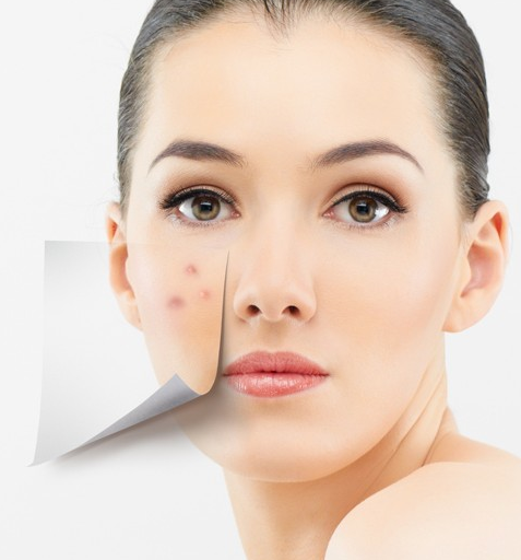 长痘小心是疾病信号