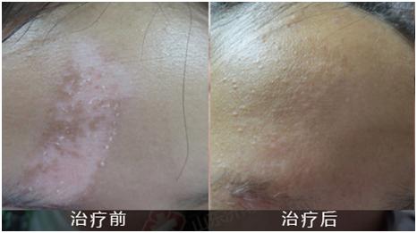 上海肤康医院坚强相伴,白癜风女孩终得治