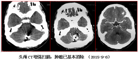 罕见脑瘤不可治?中大肿瘤医院粒子植入成功消除!