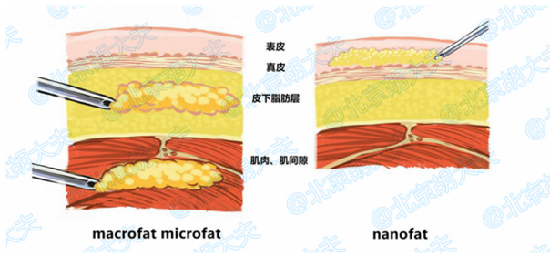 李健:脂肪移植技术新革新 美丽1+1