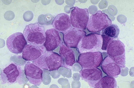 慢性粒细胞性白血病怎样治疗?