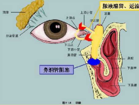 慢性泪囊炎