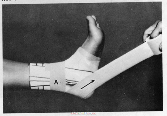 组图:踝关节的胶布固定方法(下)_滚动图集