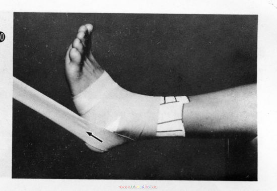 组图:踝关节的胶布固定方法(下)_滚动图集