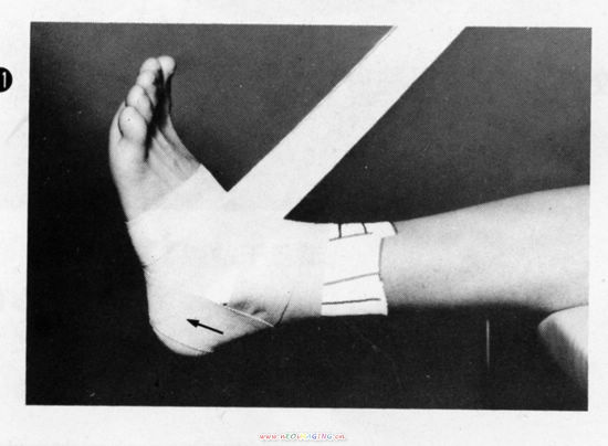 组图:踝关节的胶布固定方法(下)_滚动图集