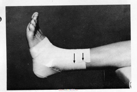 组图:踝关节的胶布固定方法(下)_滚动图集
