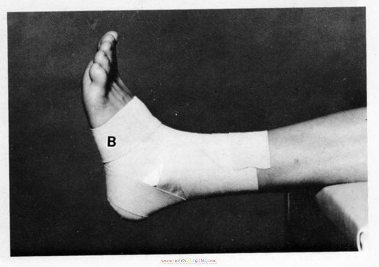 组图:踝关节的胶布固定方法(下)_滚动图集