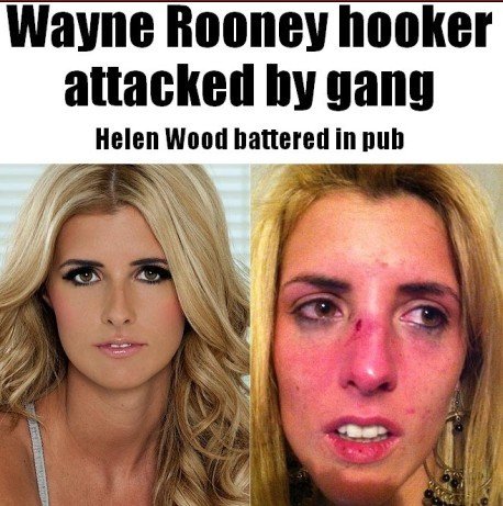 鲁尼招妓门4P女主角遭毒打面部多处淤血紫青_体