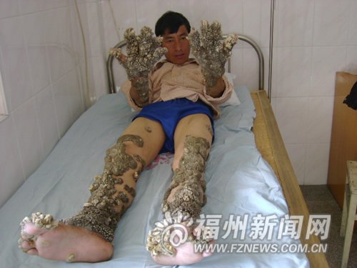 人类最罕见病变:珊瑚人和无色人种(图)_科技