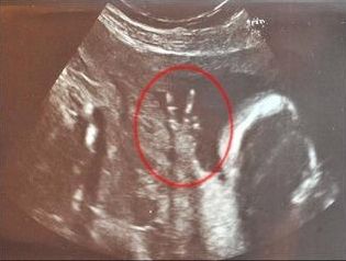 小婴儿在英国妈妈肚里比出V字胜利手势(图)