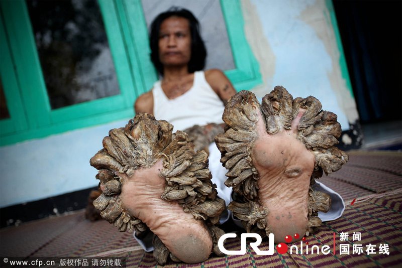 印尼怪病男子变树人+四肢长满枝根状肉瘤