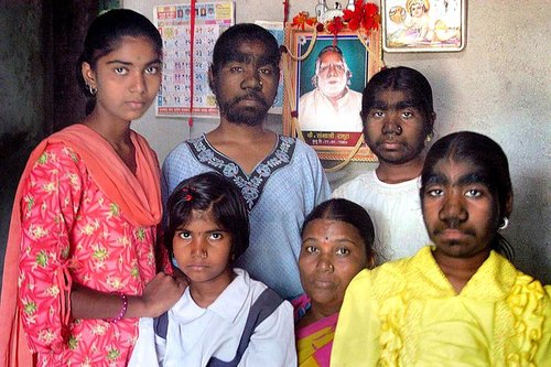 印度三姐妹患狼人综合症 发病率十亿分之一
