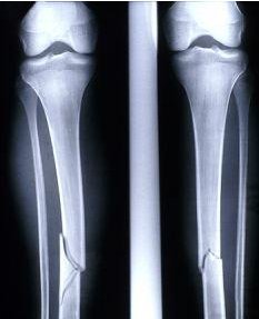 美国科学家找到“油灰” 可大大提速骨伤治疗