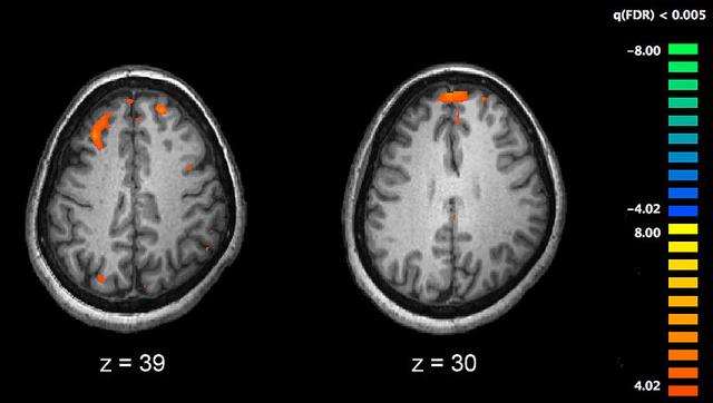 精神分裂症患者幻想症状与大脑前区褶皱有关