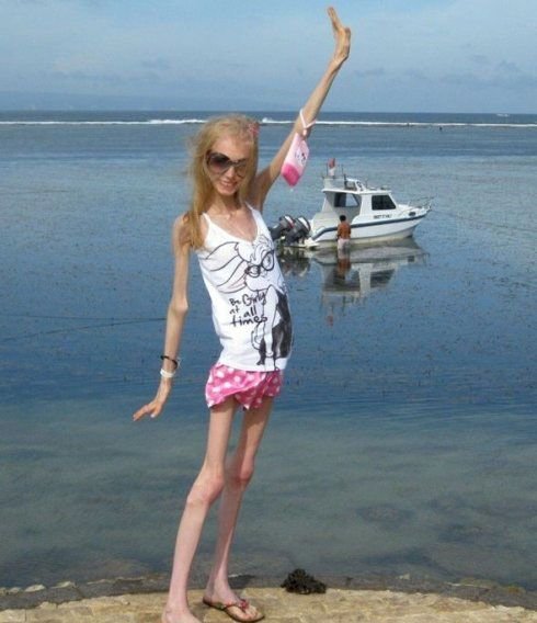 俄罗斯出现减肥达人 体重只有20公斤