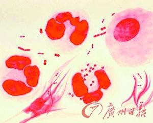 最新发现性病转化为绝症 扩散将导致巨大灾难