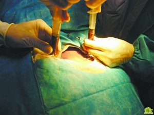 血液病治疗新方法:人工干细胞代替骨髓移植