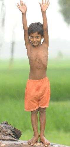 印度八肢男孩手术后首亮相 称对新身体很满意