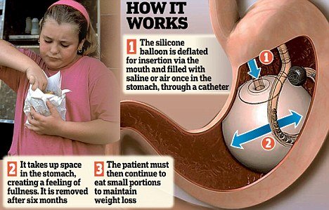 英医学专家欲尝试用胃内水球法治疗儿童肥胖_科技