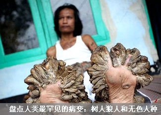 盘点人类最罕见的病变