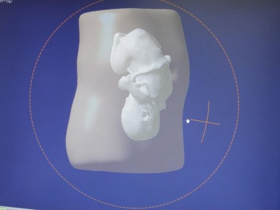 胎儿3D模型技术问世 或将取代传统超声照片