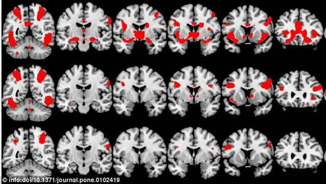 最新研究:性瘾者与吸毒者具有相似大脑活动性