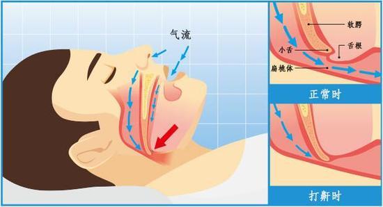 智酣垫亮相:打呼噜情况可明显改善