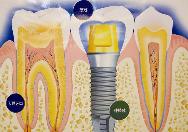 健康讲堂:种植牙不得不知的养护经