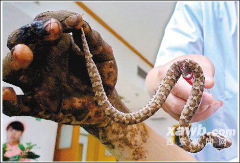 夏季毒蛇常出没 省医院两月接诊40多被咬患者