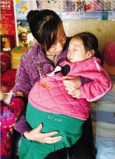 4岁女童肚子大过孕妇 疑似布加氏综合征(图)