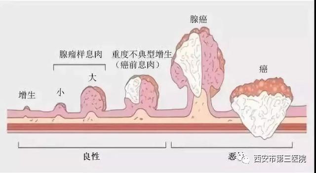 什么是大肠息肉       大肠息肉通俗来讲就是长在肠管内的肉疙瘩,可