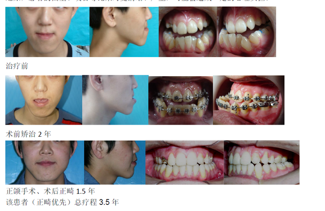 正畸手术 腾讯网