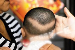 刻度不准兑出高浓度奶 女婴吃后变瘦<em>掉头发</em>_大