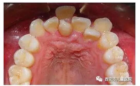 换牙期，如何让孩子“齐齿并进”?