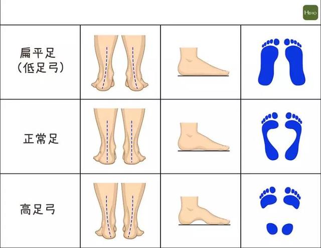 扁平足危害如此大 快看看您的宝宝属于扁平足吗?