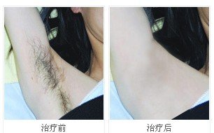 西安美立方整形美容医院专家介绍称:腋下有毛对于女性而言是很难启齿