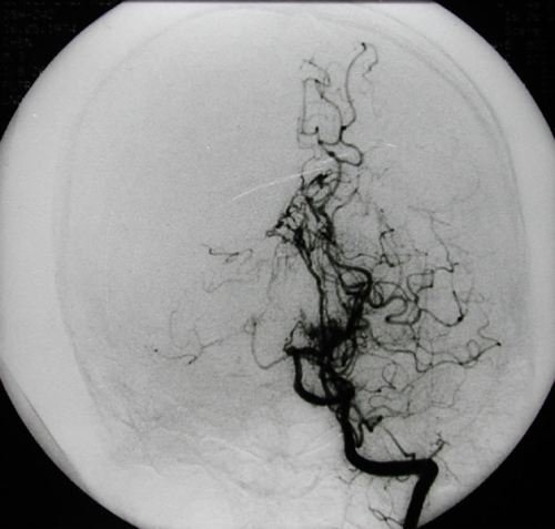 日研究人员发现与烟雾病有关的基因