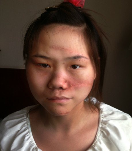 妇联求助陕西医院为毁容少女 换脸 再造重生