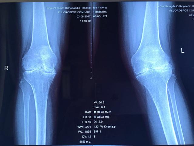 仲德骨科成功救治iv期重度类风湿性关节炎患者