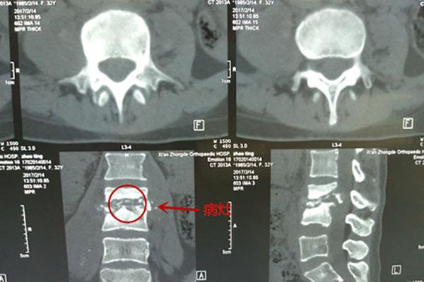 脊柱结核起病隐秘 误诊结果严重 你一定要了解