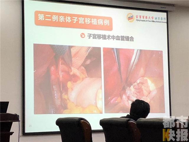 中国第二例人子宫移植手术于西京医院顺利完成